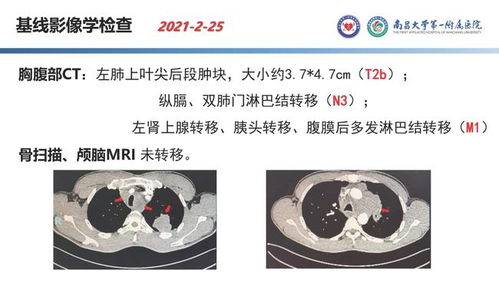 局部晚期肺腺癌治疗方法有哪些，怎么治？