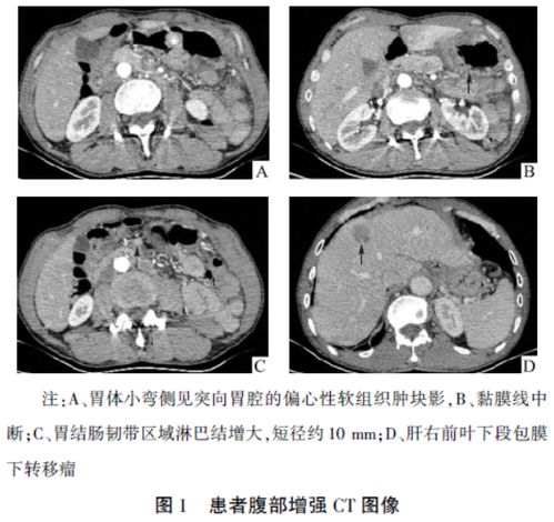 玫克微朵德国菌菇：胃腺癌扩散速度有多快？如何预防？