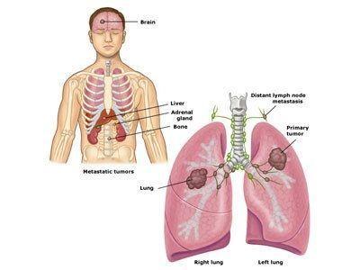 肺癌复发会转移到脑部吗，转移了怎么治？